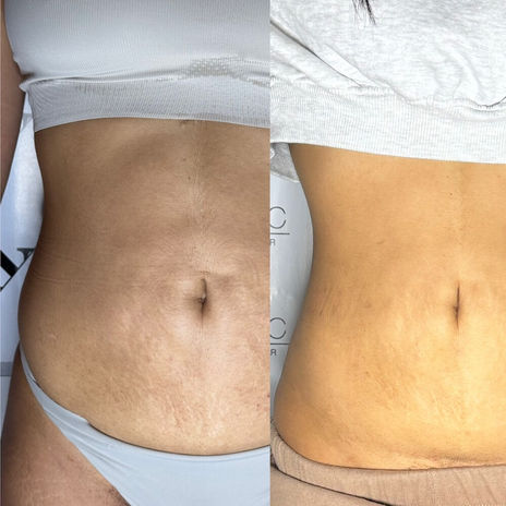 Endolift results on the abdomen: reduced skin laxity and improved definition in the midsection