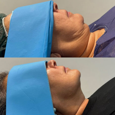 Endolift results: reduction in sagging skin and improved facial definition in a side-by-side comparison