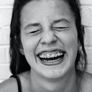 Myo & Braces: Timing Your Perfect Fit!