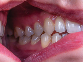 Dentist in Arcadia CA treating gum disease and bleeding gums