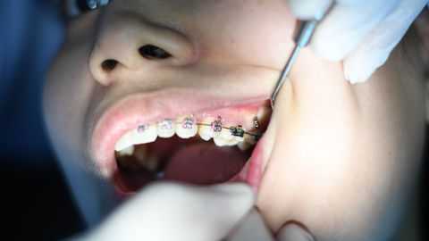Women Getting Braces