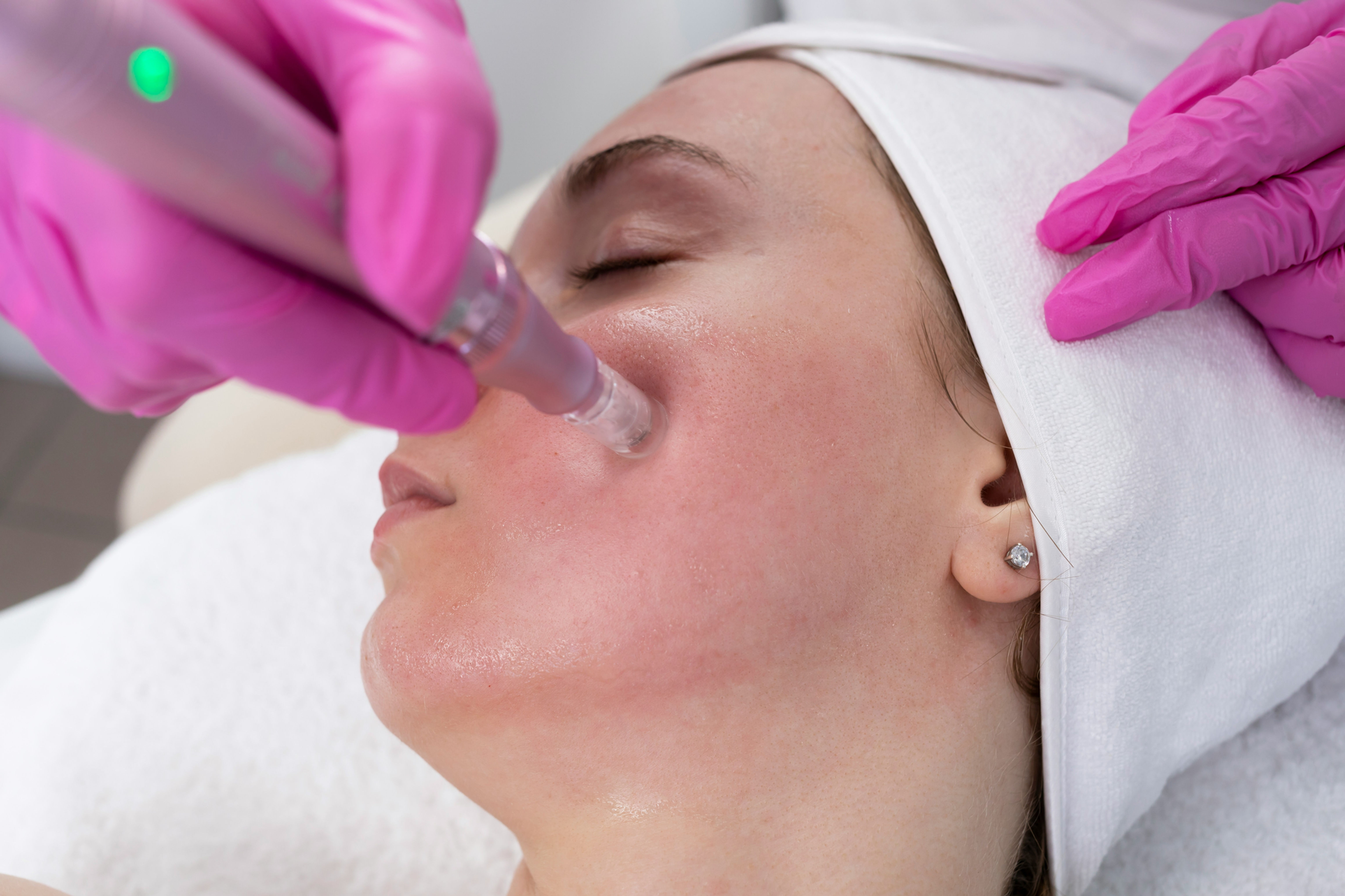 Microneedling NCTF