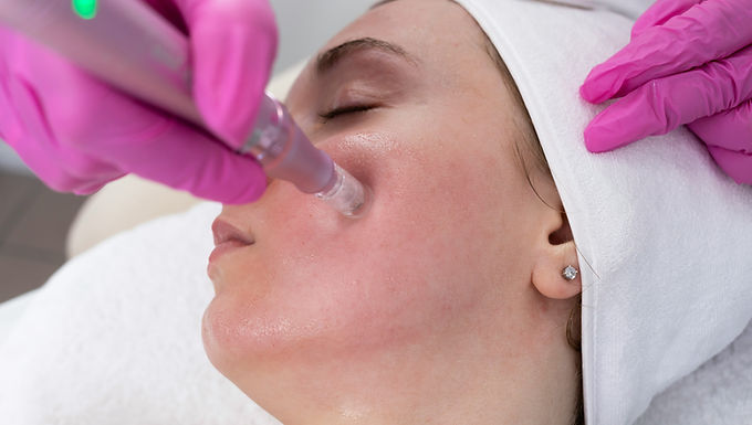 Microneedling in Worthing | Pearl Aesthetics