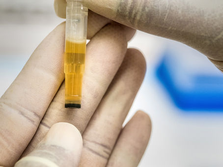 Complete Urine Examination (CUE)