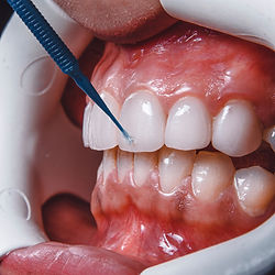 Cosmetic Service, Mouth extractor, Best teeth Whitening
