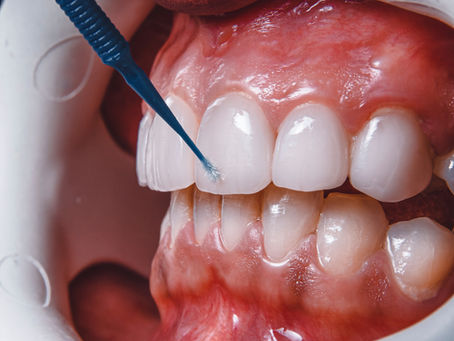 Whitening and Sensitive Teeth: What You Need to Know