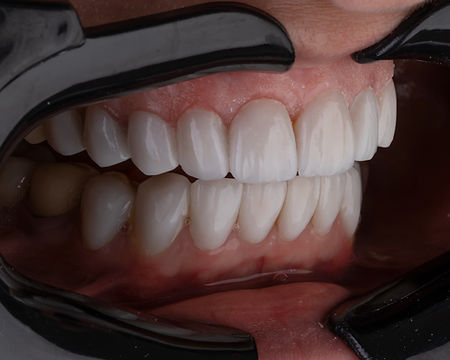 implantes de carga inmediata