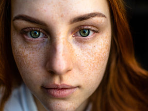 THE ACNE SOLUTIONS: How to treat the worst breakouts