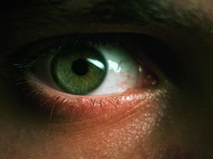 Close-up of a human eye with a green iris and visible redness in the sclera, highlighting eye irritation and vascular inflammation, commonly associated with dry eye, allergy, or ocular surface disease. | South Bay Retina, San Jose, Gilroy