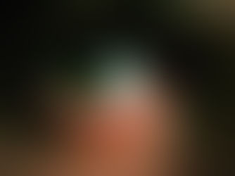 Close-up of a human eye with a green iris and visible redness in the sclera, highlighting eye irritation and vascular inflammation, commonly associated with dry eye, allergy, or ocular surface disease. | South Bay Retina, San Jose, Gilroy