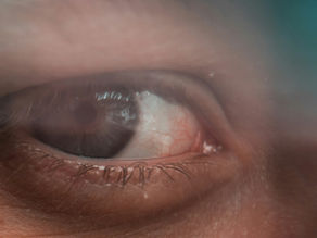 Understanding Glaucoma and Pressure Management