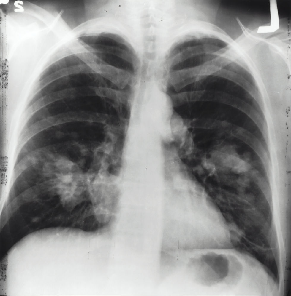 x-ray of lungs