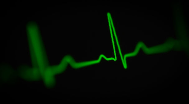 Derivacion de ECG verde sobre fondo negro