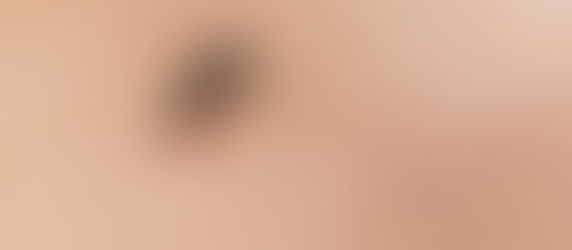 Don't let a temporary pest scar you