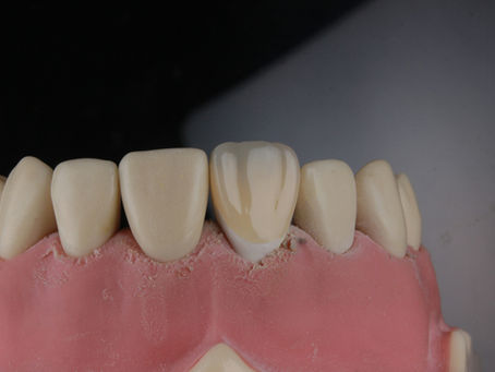 A importância do isolamento absoluto nas restaurações em resina composta