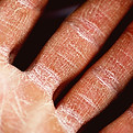 Treatment of Eczema, Skin Disorders,
