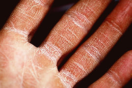 treatment for skin conditions