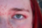 shitapiita (hives) and skin issues