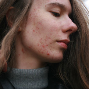 PCOS and Hormonal Acne: Why It Happens and What You Can Do