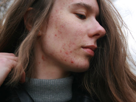 Acne: What Can Be Done