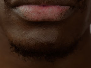 Why Do Dark Marks Take SO Long to Fade? (And What Actually Works)