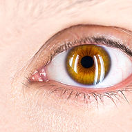 Cataracts