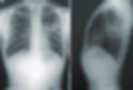 Radiografia de tórax mostrando uma área de pneumonia