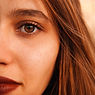 Melasma