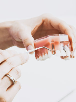 Impianto dentale: tutto quello che devi sapere per un sorriso sano e duraturo