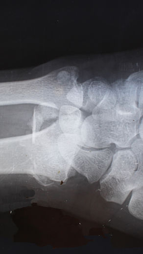 Osteoporosis y Sarcopenia: Cómo Mantener la Fuerza y el Equilibrio