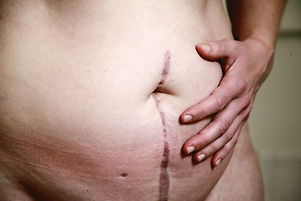 Image of an abdomen with a surgical scar from belly button down.