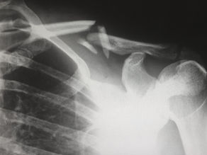 5 top tips for injury prevention: Reaching your fitness goals.