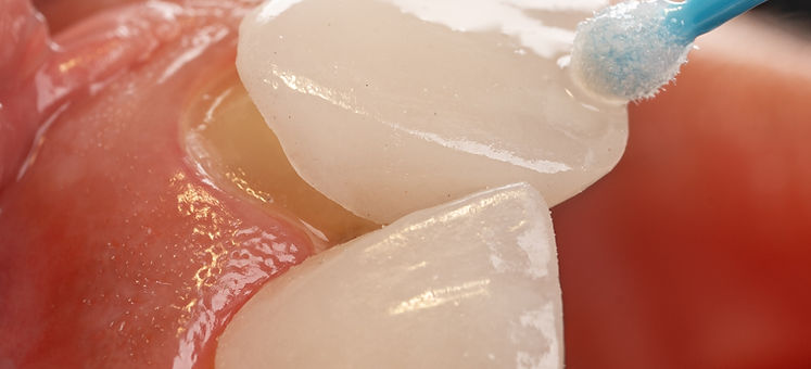 Transform Your Smile with Dental Veneers in Vienna, VA
