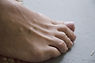 Toe Fungus