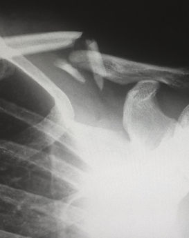 X-ray of broken collar bone