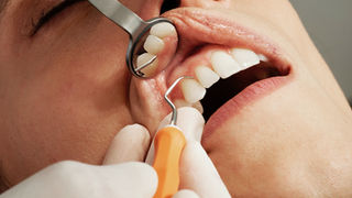 Can a Cavity Heal Itself? What Enamel Remineralization Can Do for Your Teeth
