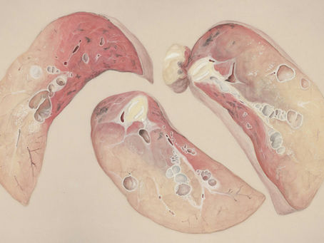 Distomatose hépatique