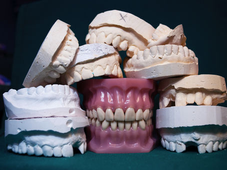 Tooth Replacement 101: Comparing RPDs, FPDs, and Implants