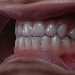 Teet whitening process, Cosmetic Service, Mouth extractor, Best teeth Whitening