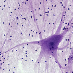 Activité musculaire spontanée dans la neuropathie motrice multifocale : les apports des tests d'excitabilité axonale