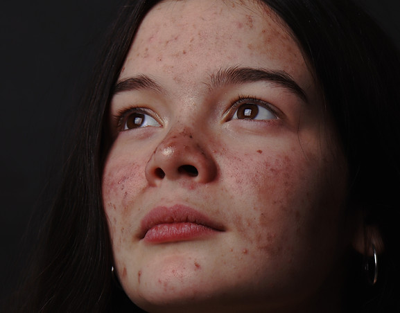 acne,acne scar, pimple mark ,acne treatment, remove pimple mark ,remove acne , reduce acne scar,暗疮治疗,去除痘疤,去除痘印, kuching acne treatment, 古晋除暗疮护理