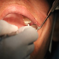 Extracción Dental