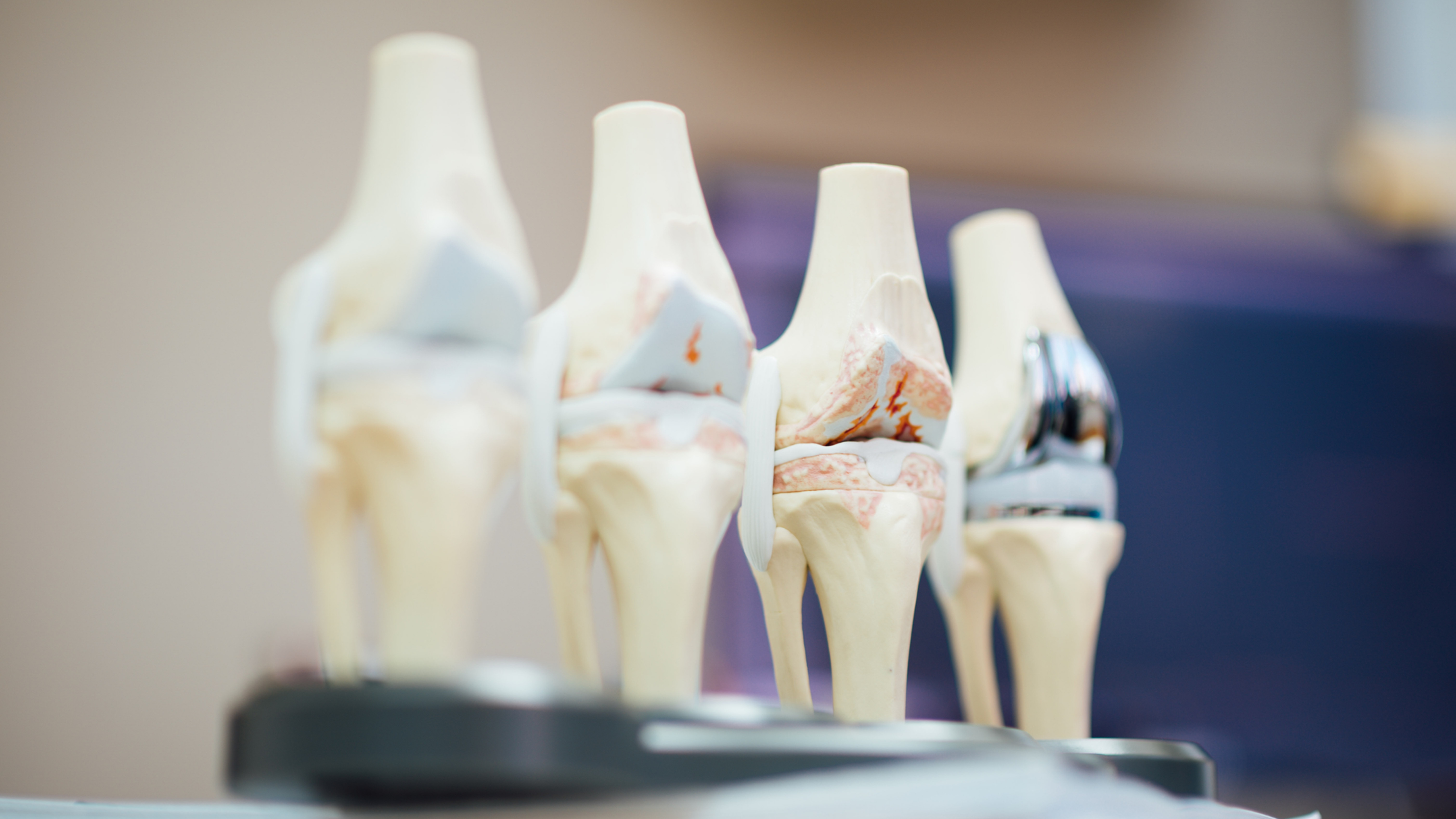 These knee models show how osteoarthritis can change the joint as cartilage wears down, leading to pain, stiffness, and reduced mobility