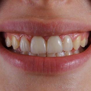 woman teeth