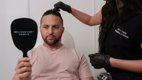 Botox, injections : ce que les hommes doivent vraiment savoir