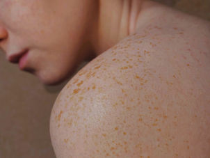 help identify melasma triggers