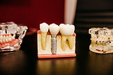 IMPLANTS | Skye Dental | General & Aesthetic Dentistry | Orthodontics | Singapore | Dr. Andrew | Dr. May