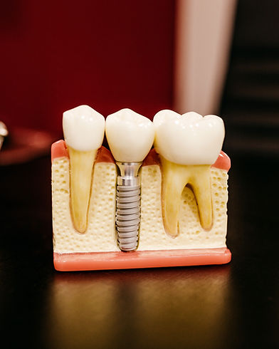 Implantes Dentales | CasaDens