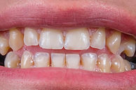 Sorriso amarelado e dentes separados. Indicativo de necessidade de Lentes ou facetas dentais