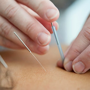 close up of acupuncture needle in skin